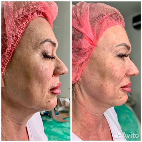 Аппаратное омоложение