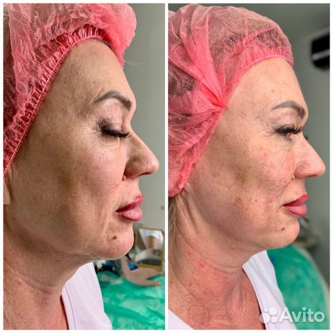 Аппаратное омоложение