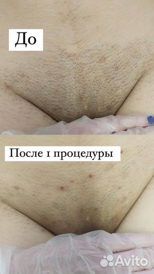 Лазерная эпиляция