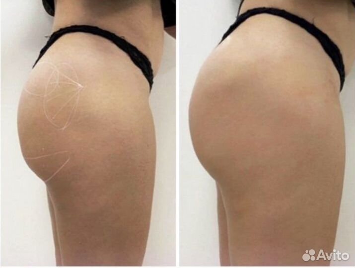 Увеличение ягодиц