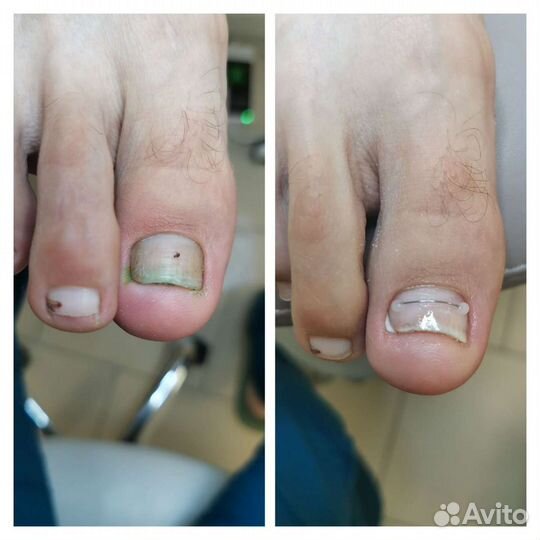 Подолог. Медицинский педикюр.Сергиев Посад
