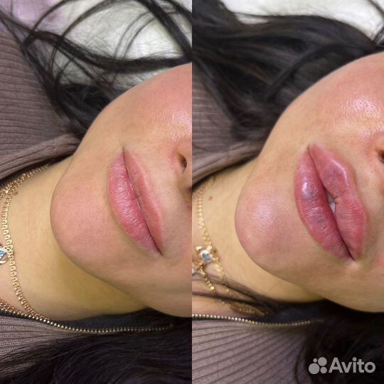 Увеличение губ