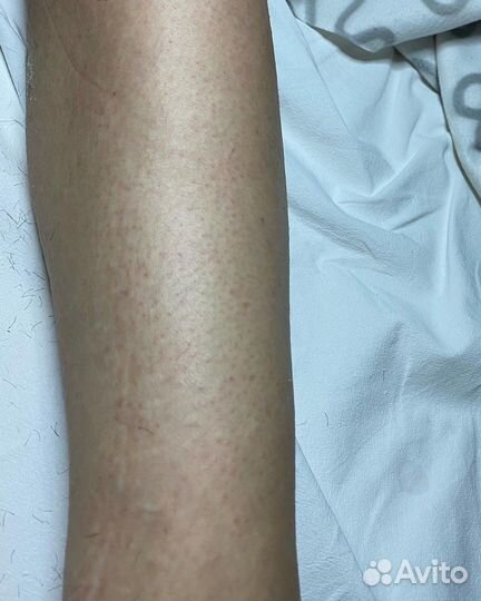 Электроэпиляция