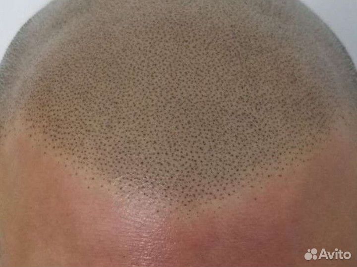 Трихопигментация кожи головы.Для мужчин и женщин