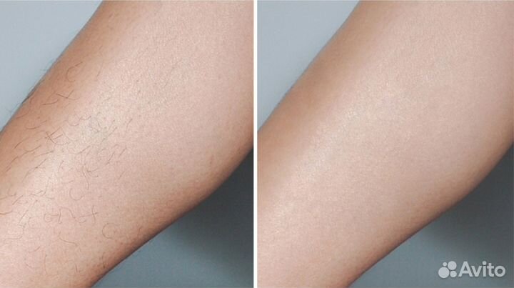 Модели / лазерная эпиляция / депиляция