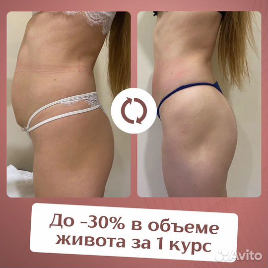 LPG-массаж - красивые формы без боли