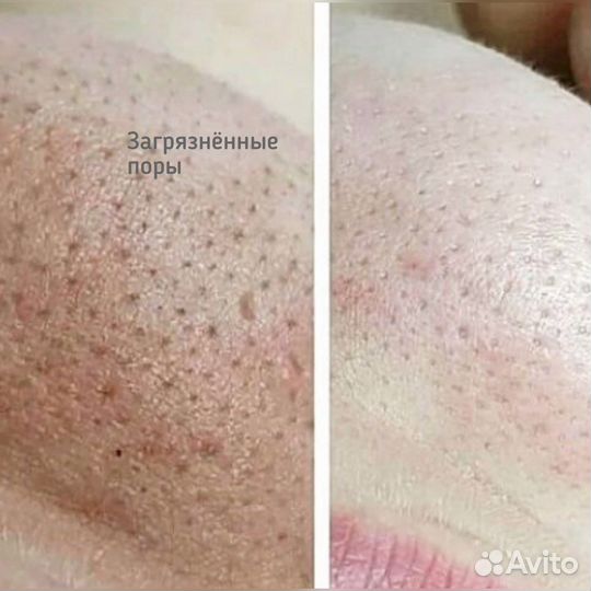 Косметолог/Челны/Чистка лица