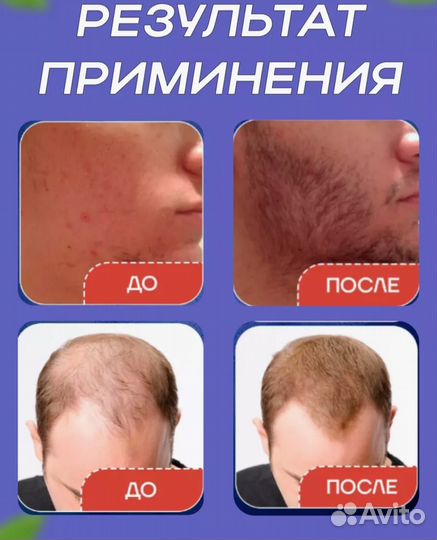 Миноксидил 25 для роста бороды