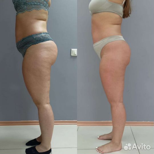 Антицеллюлитный массаж