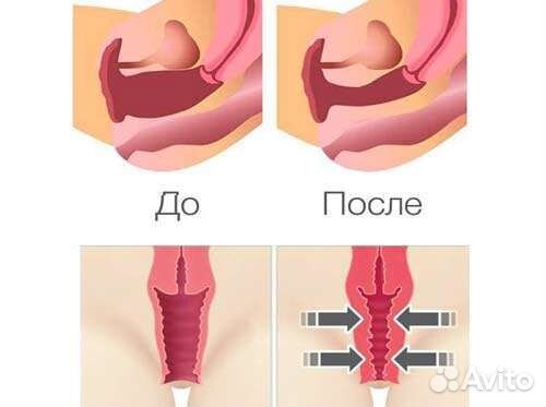 Смас лифтинг вагинальное сужение