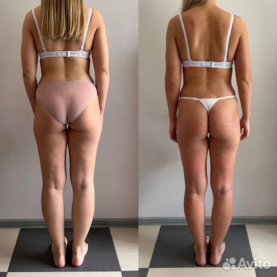 Прессотерапия