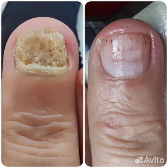 Педикюр Подолог