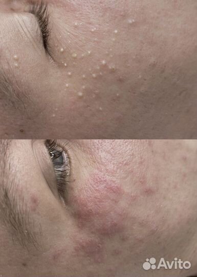 Чистка лица