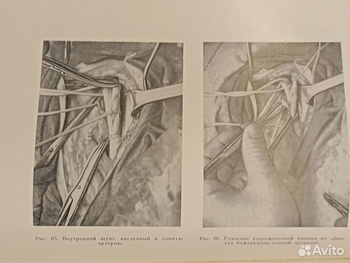 Нарушения мозгового кровообращения и их хирургичес