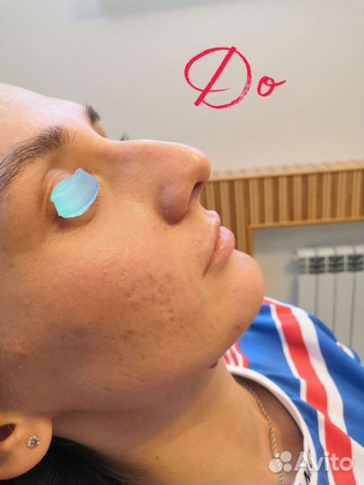 Коррекция формы носа