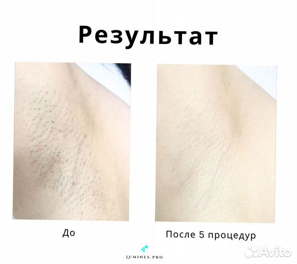 Диодный лазер для эпиляции Lumines MaxOne 1200 Вт