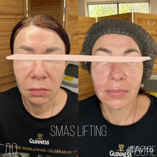 Smas lifting Омоложение кожи