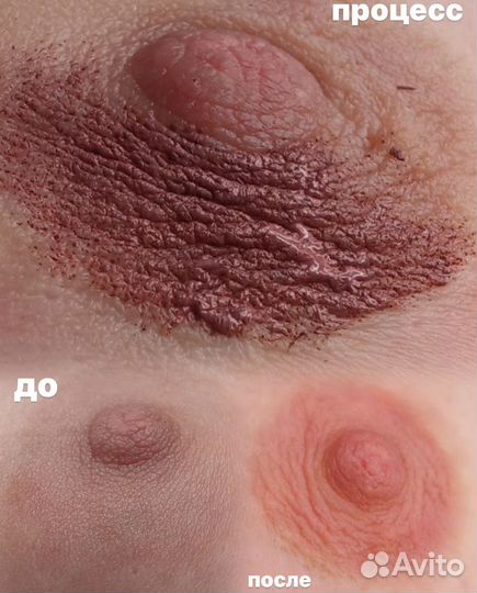 Камуфляж шрамов, цветокоррекция ареол, растяжки