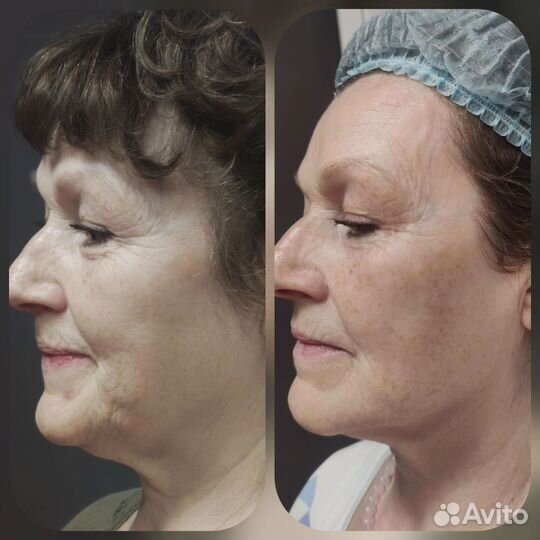 LPG массаж на оригинальном Французском аппарате