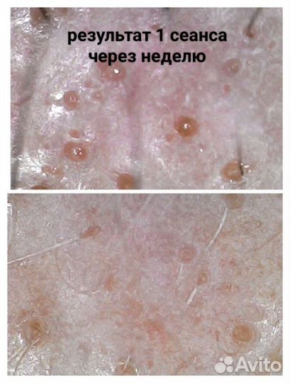 Лечение выпадения волос