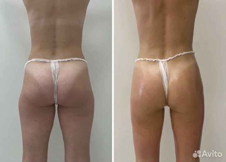 Массаж коррекция фигуры(жиротоп)