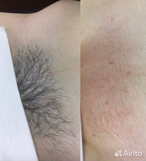 Восковая депиляция