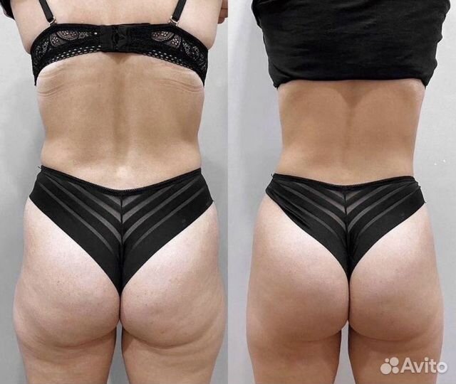 LPG массаж. Похудение