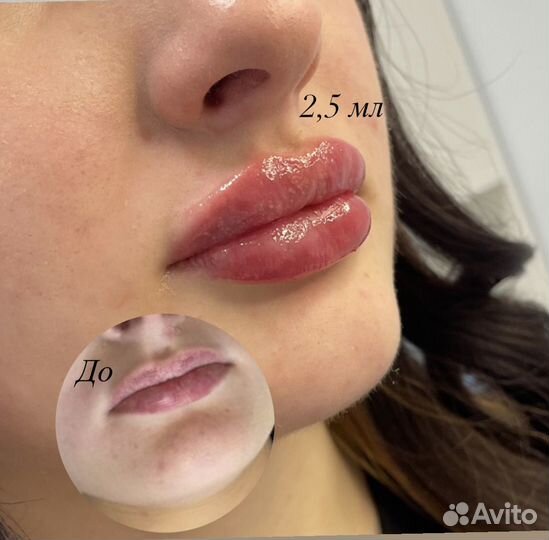 Увеличение губ/Косметолог/ ботокс