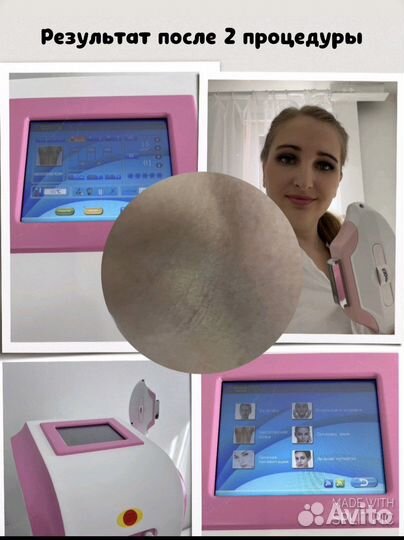 Лазерная эпиляция