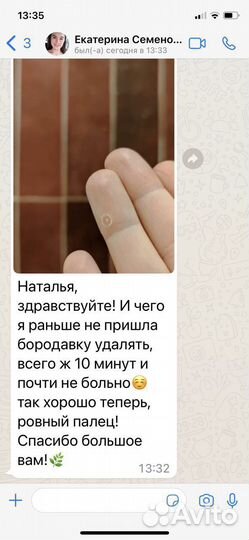 Удаление бородавок и папиллом Жидким Азотом