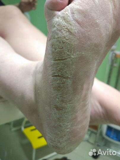 Педикюр. Подолог