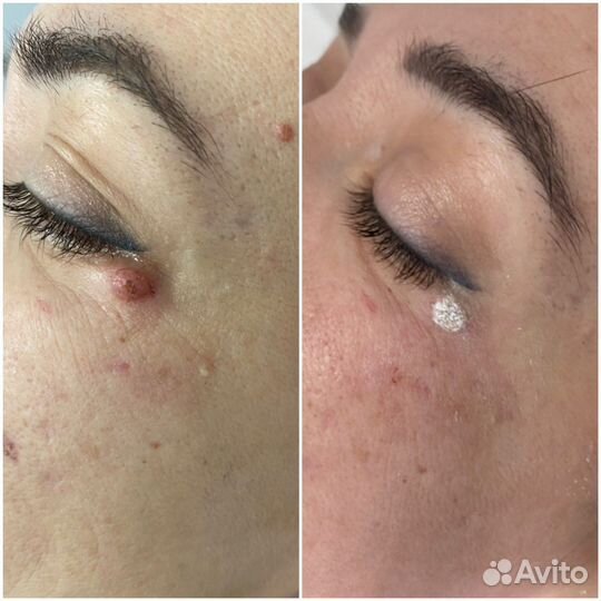 Удаление папилом, фибром, родинок