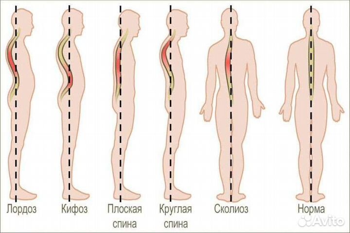 Скалиоз, массаж при скалиозе