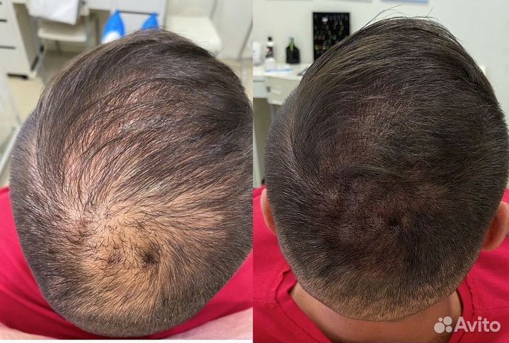 Трихопигментация мужская загущение волос