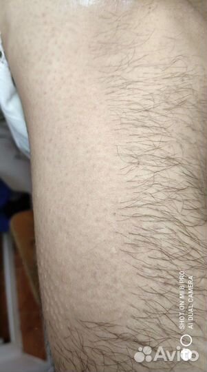 Электроэпиляция: бёдра