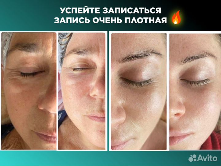 РФ лифтинг Чистка Омоложение подтяжка лица