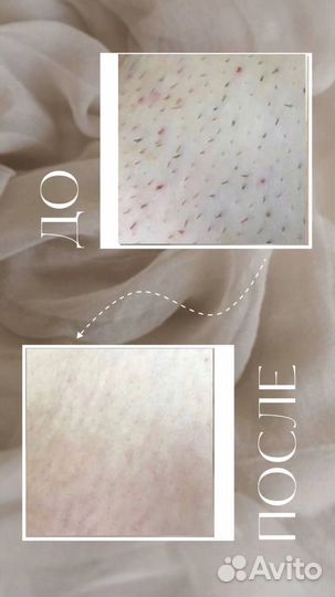 Лазерная эпиляция