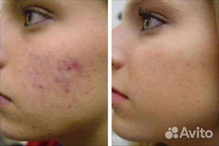 Щетка для глубокого очищения лица Skinvigorate