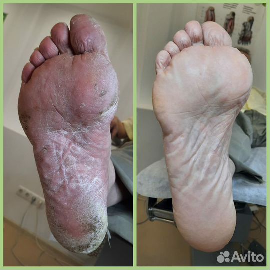 Подолог со стажем. Любые проблемы ног и рук