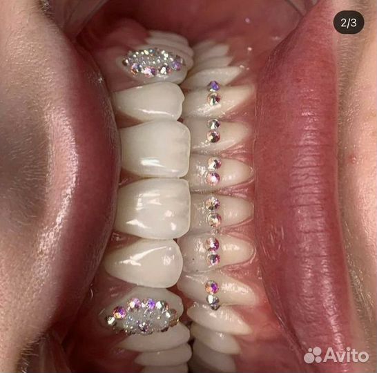 Скайсы стразы на зубы