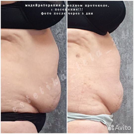 Антицеллюлитный массаж / коррекция фигуры / LPG