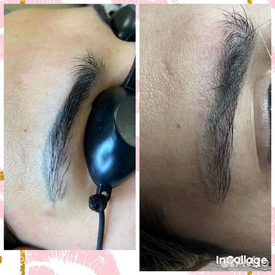 Лазерная эпиляция: бакенбарды