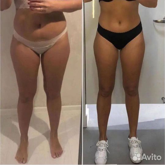 Прессотерапия