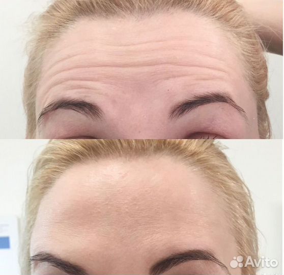 Ботокс для лица