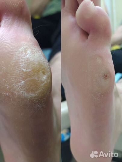 Подолог, педикюр