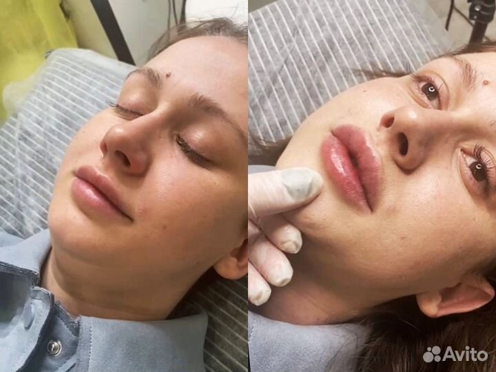 Косметолог. Увеличение губ