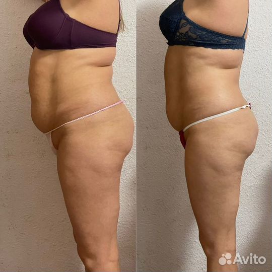 Коррекция фигуры