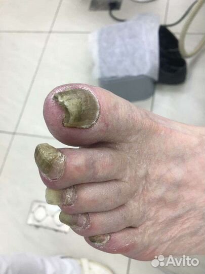 Медицинский педикюр подолог