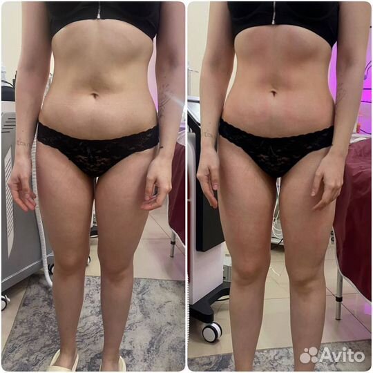 Кавитация, LPG, вакуумный