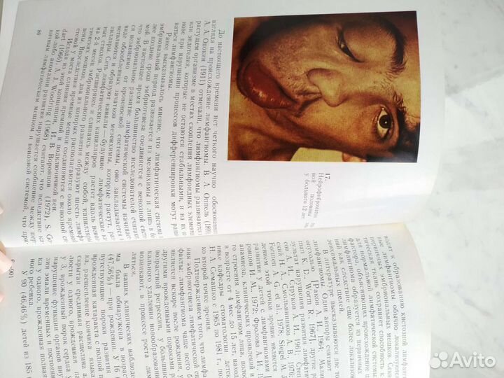 Новообразования мягких тканей и костей лица у дете